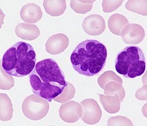 末梢血ATL細胞